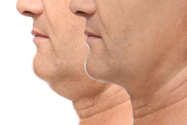 HIFU - Breakthrough in Anti - ageing 2 hifu results Harrow