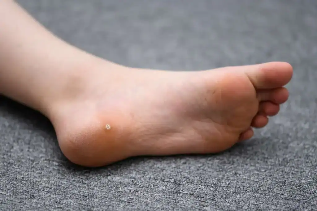 Cryotherapy For Warts And Also Verrucas 2 Image of verruca on the bottom of the foot that able to be treated with Cryotherapy Harrow