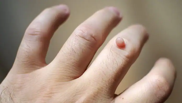 Image of blemish that Cryotherapy Harrow can remove with Lipo 360.