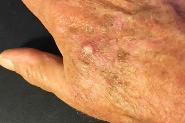Cryopen For Actinic Keratoses 1 Image of Actinic keratoses Harrow on a person hand