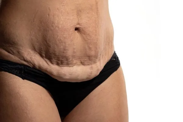 The Science of Skin Tightening 1 The science behind skin tightening Harrow picture of a woman's sagging skin on the stomach